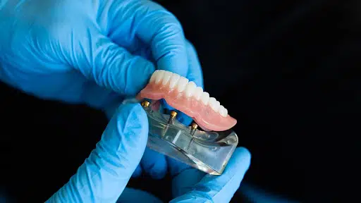 całkowita proteza zębowa mocowana na implantach
